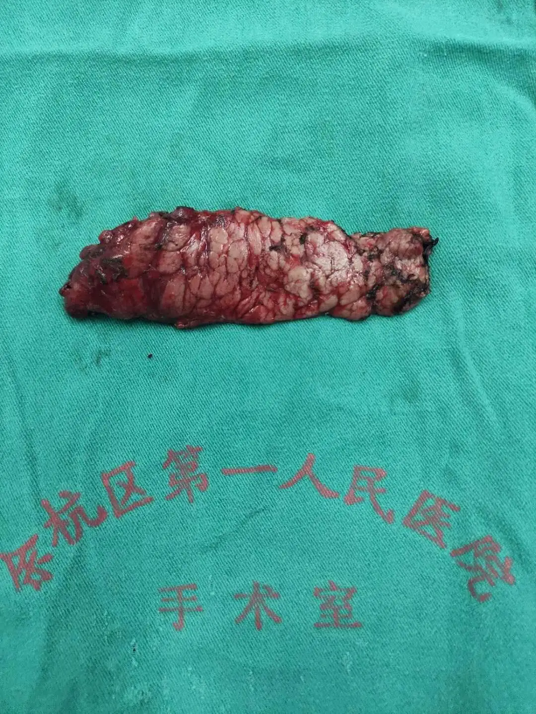 脾和胰腺切除能活多久(脾和胰腺都切除了怎么办)