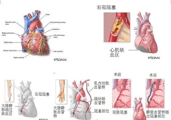 心脏搭桥手术能维持多少年(心脏搭桥手术能维持多少年呢)