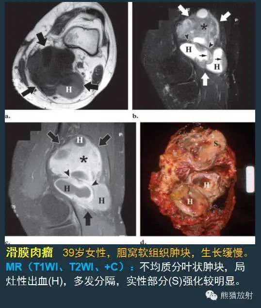 小圆细胞肉瘤能活多久(小圆细胞肉瘤能活多久呀)