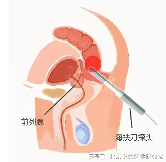 前列腺有瘤一般能活多少年(前列腺有瘤一般能活多少年啊)