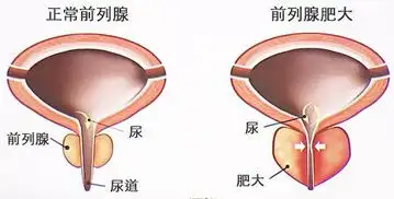 前列腺有瘤一般能活多少年(前列腺有瘤一般能活多少年啊)