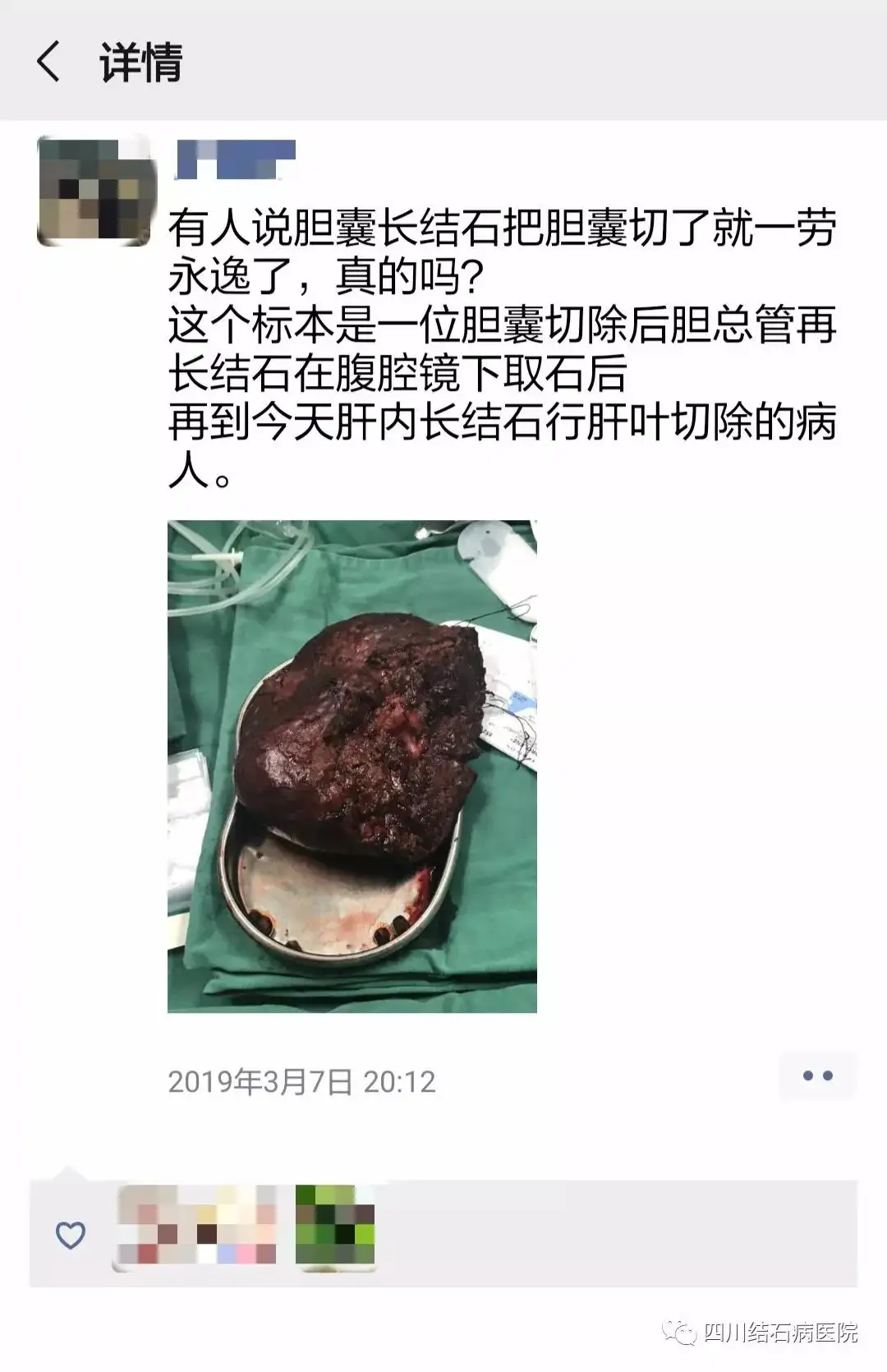 人的苦胆切除后能活多少年(人的苦胆切除了有什么影响没有)