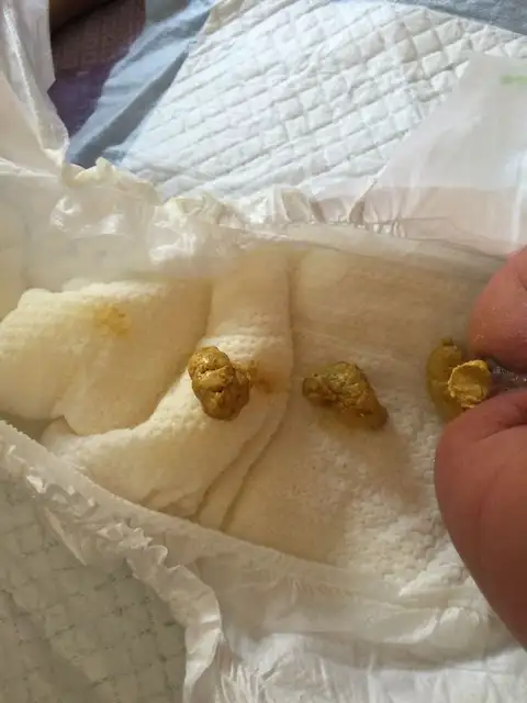 小孩便秘大便发黑(小孩便秘大便黑色的)