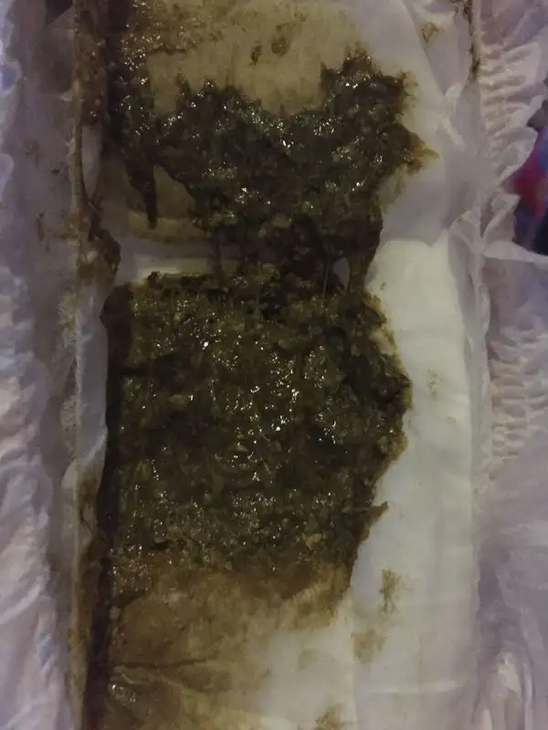 小孩便秘大便发黑(小孩便秘大便黑色的)